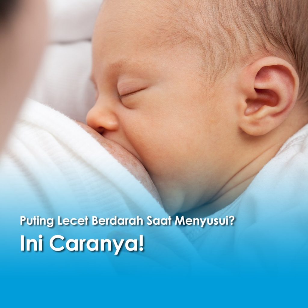 Bayi sedang menyusu di payudara ibu, ilustrasi puting lecet berdarah saat menyusui.
